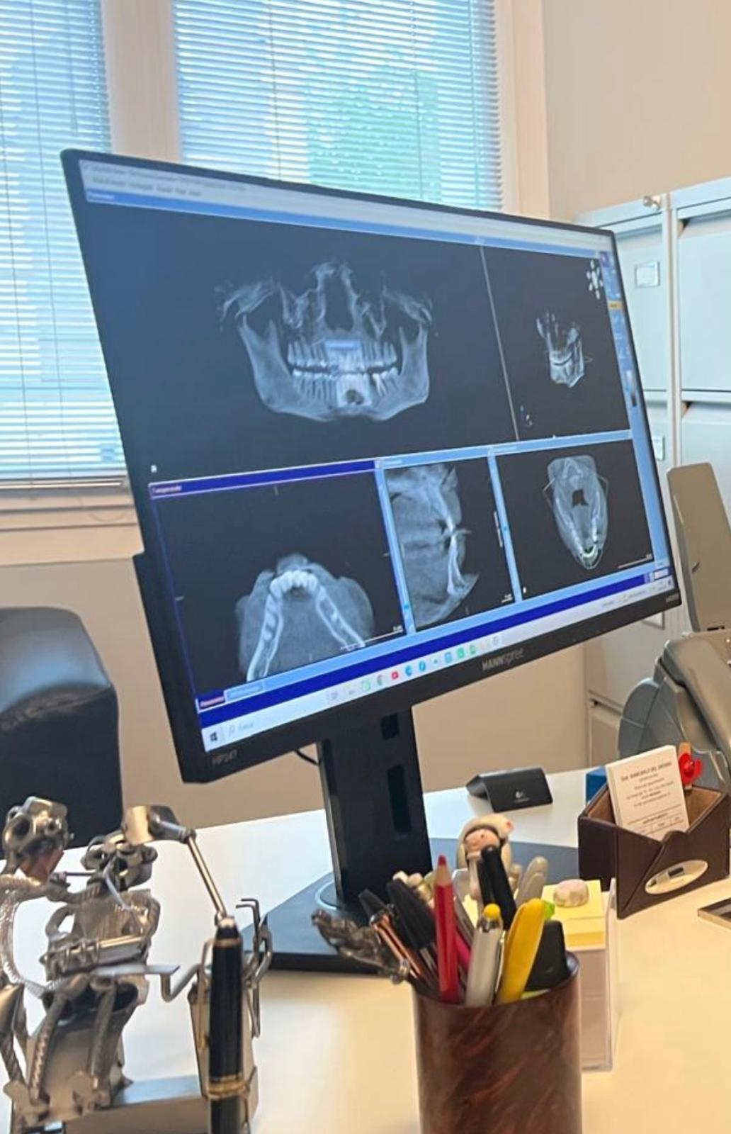 Chirurgia orale e posizionamento di un impianto dentale