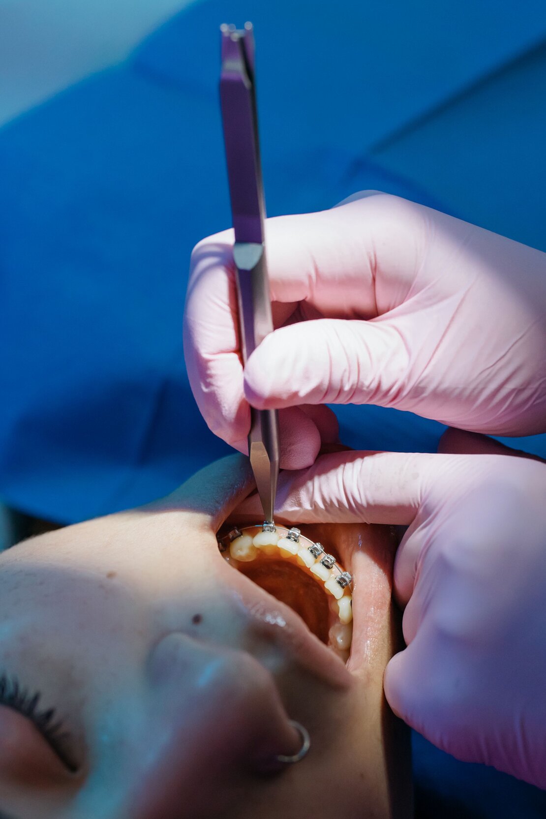 Apparecchio tradizionale e allineatore trasparente per ortodonzia